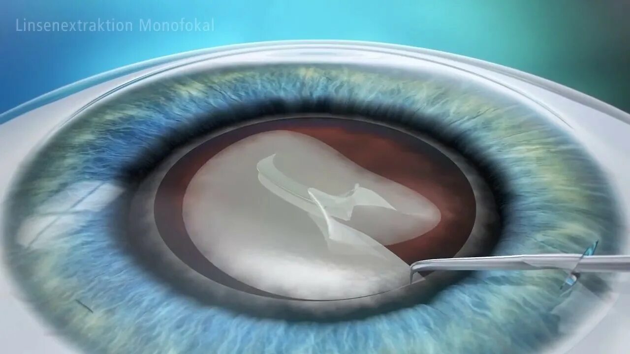 Катаракта факоэмульсификация. Факоэмульсификация катаракты с имплантацией ИОЛ.