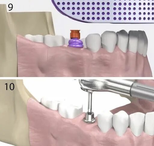 Зубы импланты поэтапно. Формирователь десны на имплант что такое. Как ставятся импланты зубов этапы установки. Имплант зубной штатив. Имплантация зубов поэтапно.