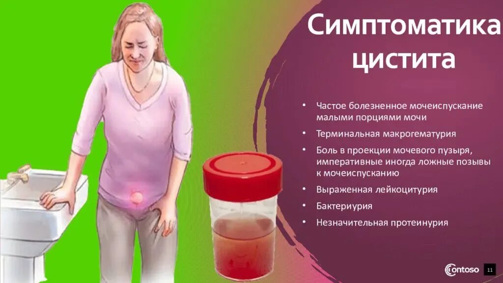 Почему ночью чаще мочеиспускание. Цистит частое мочеиспускание. цистит симптоматика. цистит уретрит у женщин. проблемы с мочеиспусканием.