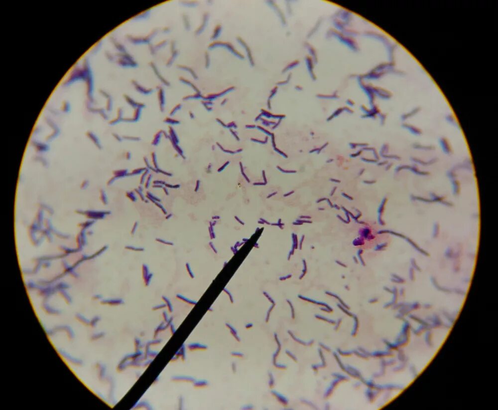 Удаление поверхностных инородных тел из глаза. Инстилляция глазных капель в конъюнктивальный мешок. Цитологическое исследование соскоба с конъюнктивы. Мазок с конъюнктивы. Мазок с конъюнктивы.