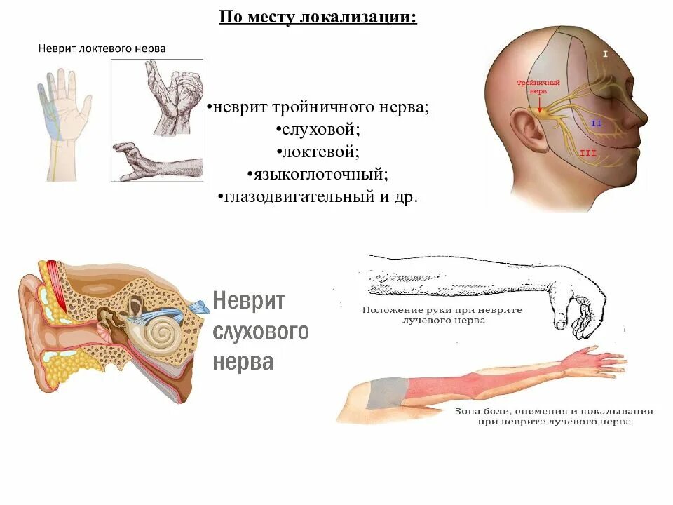 Поражение слухового нерва. Неврит. Невропатия тройничного нерва. Неврит слуховых нервов.