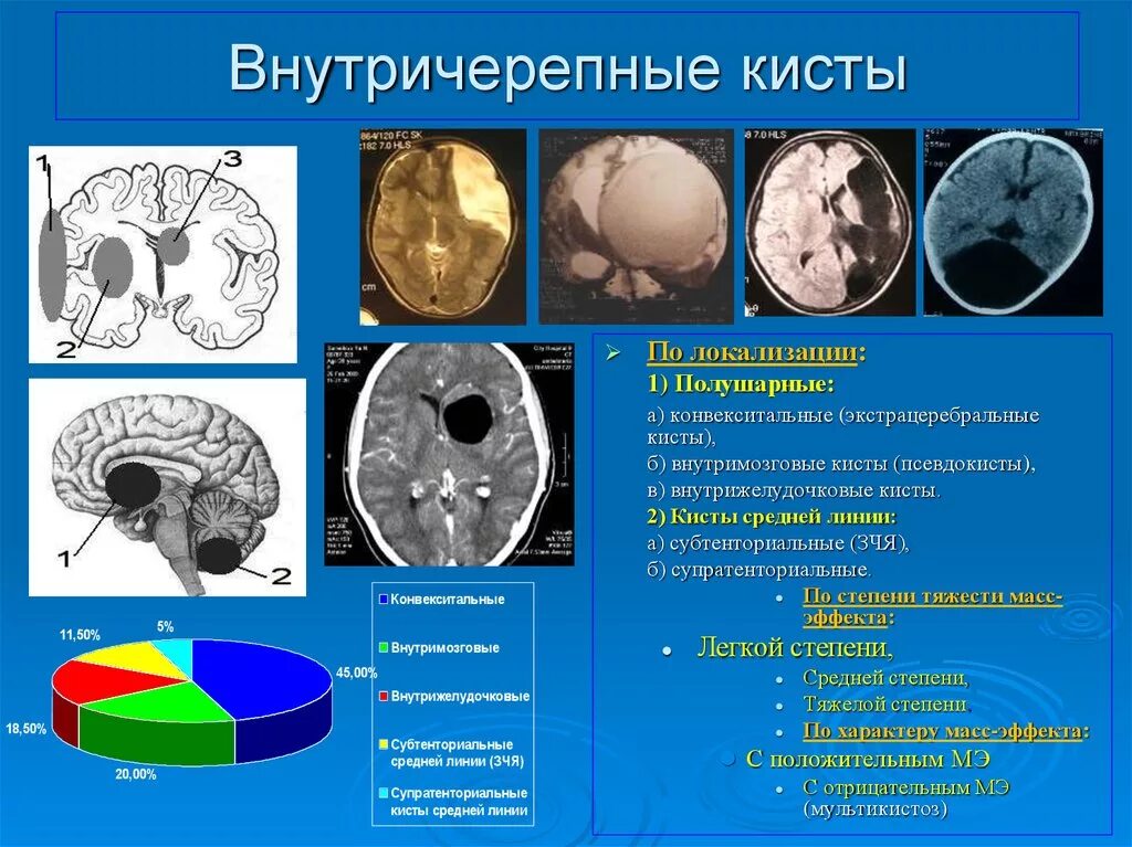 Киста в мозгах последствия. Арахноидальные кисты головного мозга классификация. Кистозные образования головного мозга. Опухоль головного мозга киста. Субарахноидальные кисты.