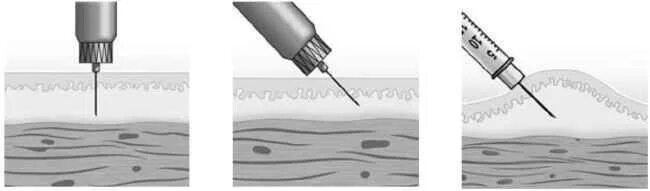Градусы введения иглы. Внутрикожная инъекция инсулин. Техника введения инсулина подкожно шприц ручкой. Техника введения инсулиновым шприц. Подкожная инъекция угол введения иглы.