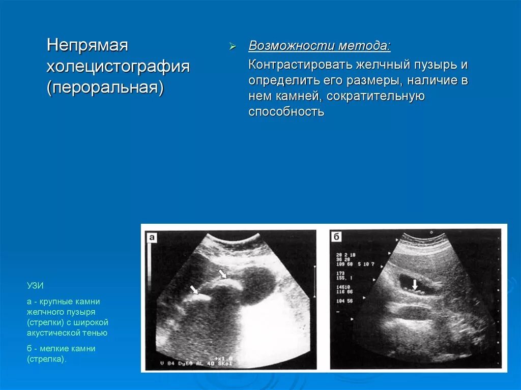 Узи сократимости желчного пузыря. Конкременты желчного пузыря УЗИ. УЗИ желчного пузыря желчекаменная болезнь. Желчнокаменная болезнь УЗИ. УЗИ желчного пузыря конкременты 1.7 мм.