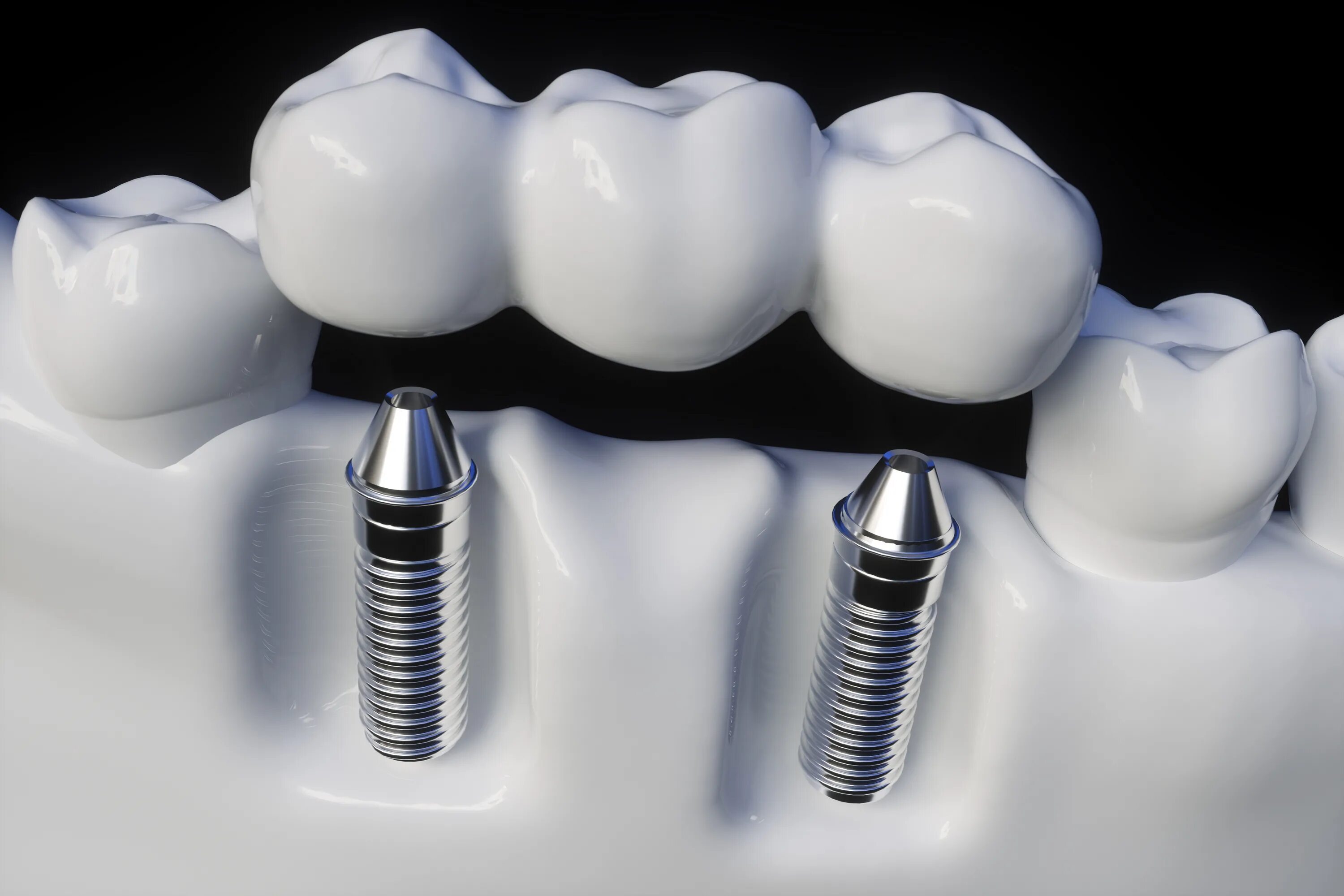 Titanium implants