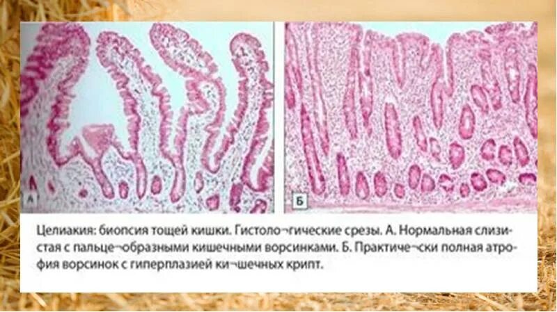 Биоптат слизистой оболочки. Целиакия гистология кишечника. Целиакия морфология биоптата. Гистология при целиакии. Целиакия патологическая анатомия.