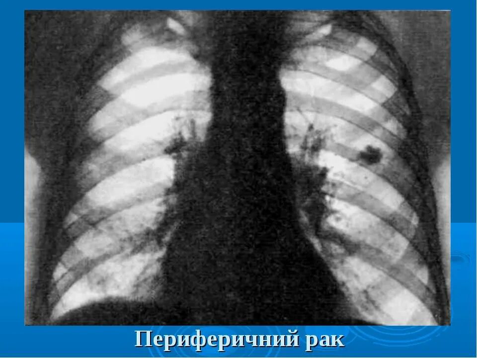 Казеозная пневмония рентген. Периферический туберкулез легких. Казеозная пневмония туберкулез. Опухоль левого легкого верхней доли. Периферическое образование левого легкого