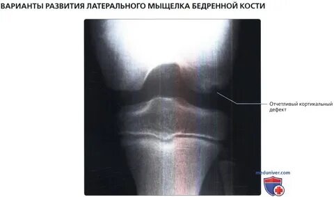 Контузия мыщелка