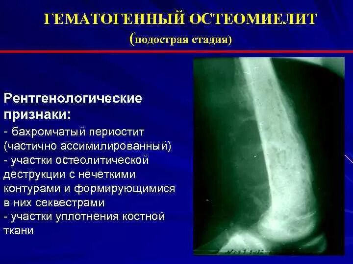 Остеомиелит: симптомы, лечение острого и хронического остеомиелита, диагностика 