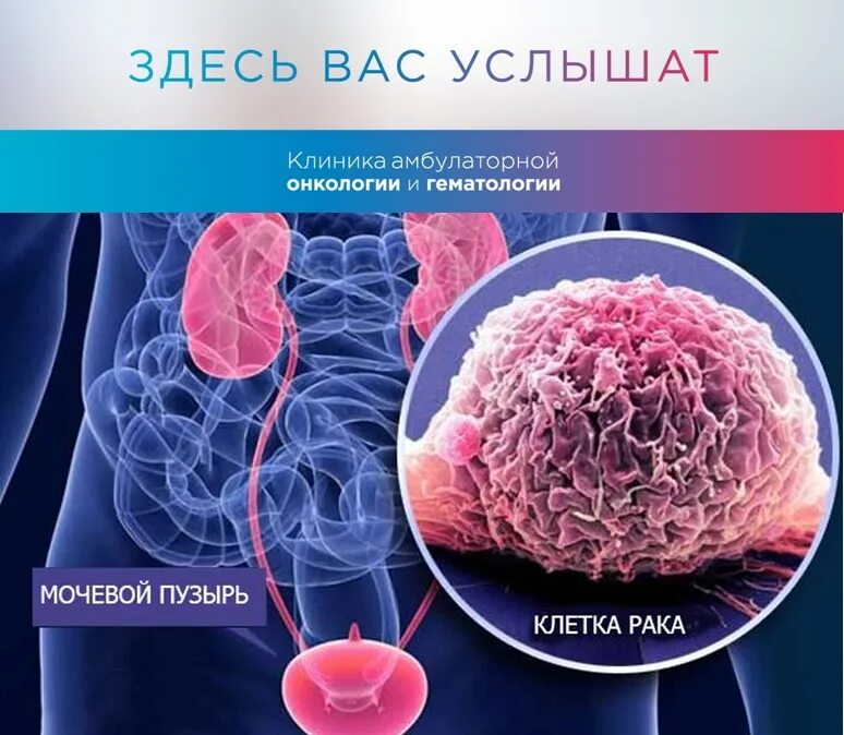 Лечение рака мочевого пузыря у мужчин. Злокачественная опухоль мочевого пузыря. Аденокарцинома мочевого пузыря. Раковая опухоль мочевого пузыря. Опухоль мочевого пузыря снимок.