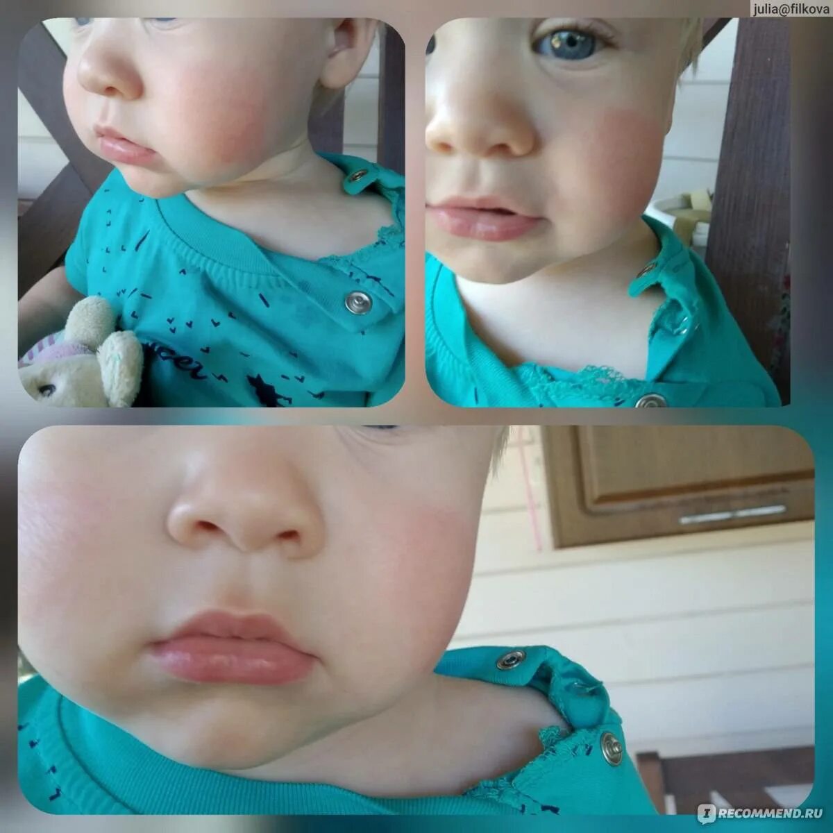 Аллергия на молек у детей. Аллергия к белкам коровьего молока у детей диагностика. Аллергия на белок коровьего молока у грудничка. Как проявляется аллергия на белок молока. Как проявляется аллергия на белок молока.