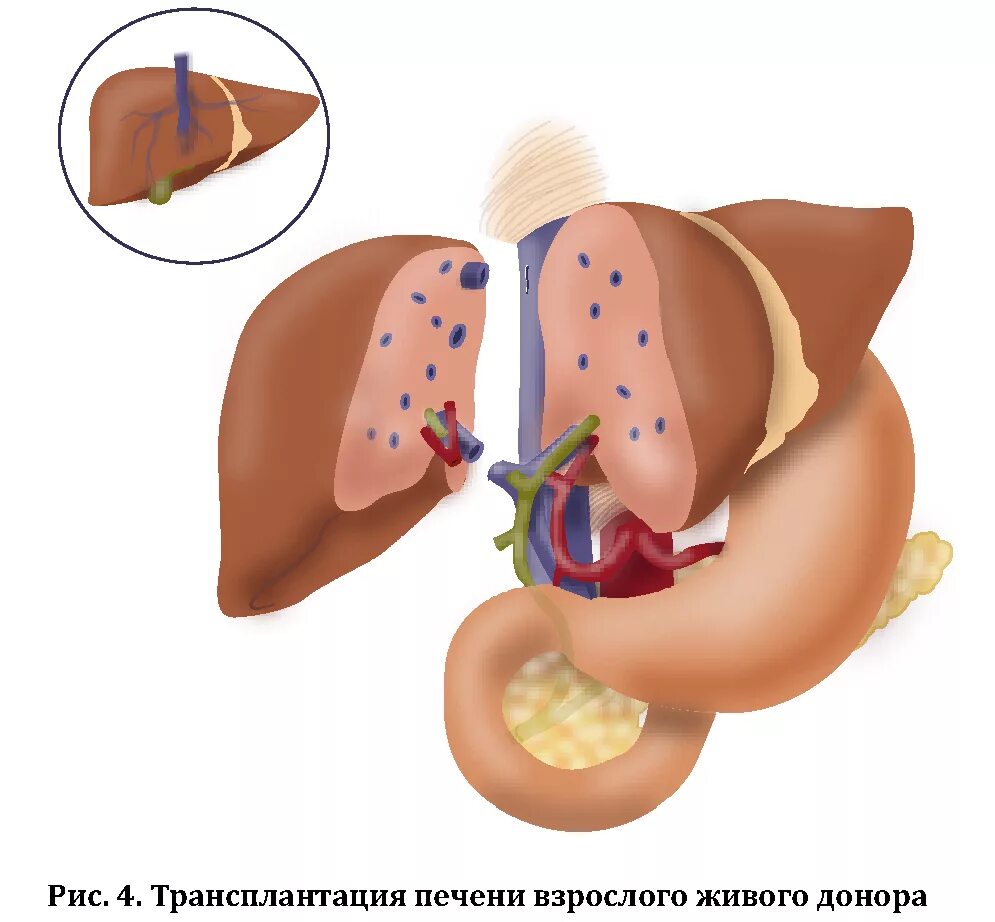 Стал донором печени. Трансплантация печени. Трансплантология печени. Операция по трансплантации печени. Аллотрансплантация печени.
