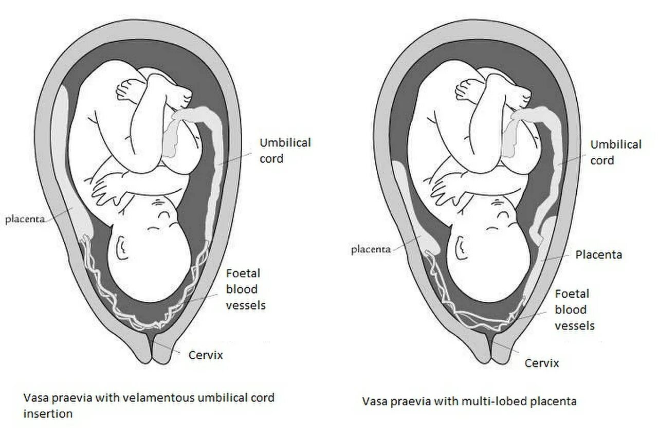 Vasa previa предлежание сосудов. Предлежание плаценты. Плацента перекрывает внутренний зев. 13 неделе беременности плацента