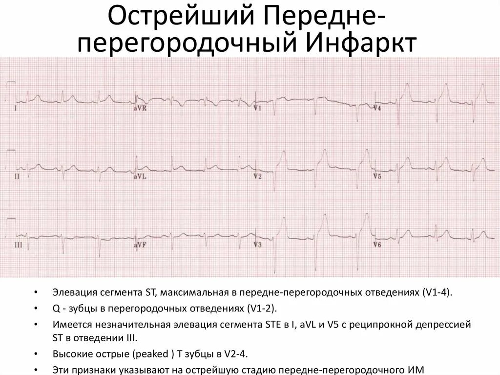 Изменение миокарда передне перегородочной области. Инфаркт переднеперегородочной области на ЭКГ. Острый трансмуральный инфаркт передней стенки на ЭКГ. Инфаркт передней стенки на ЭКГ. Острый трансмуральный инфаркт ЭКГ.