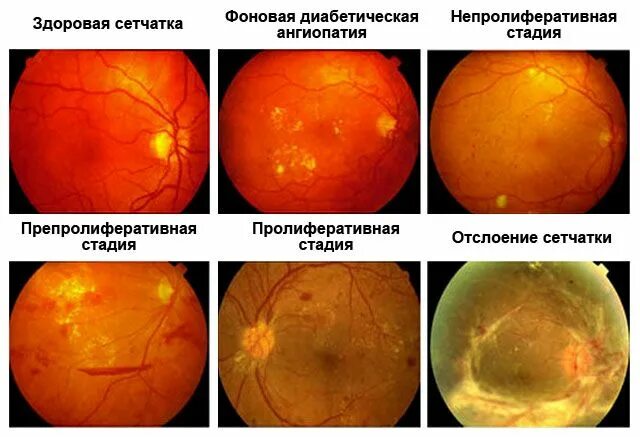 Диабетическая ретинопатия глазное дно. Диабетическая ангиопатия сетчатки стадии. Препролиферативная диабетическая ретинопатия глазное дно. Ангиопатия сосудов сетчатки что это