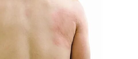 Koude-urticaria: jeukende bulten Oplossing Sproet 
