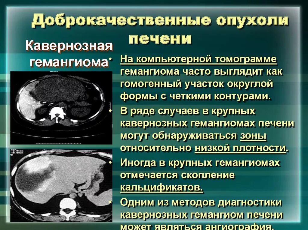 Доброкачественная опухоль. Доброкачественные и злокачественные опухоли печени. Доброкачественные новообразования печени. Округлые образования печени