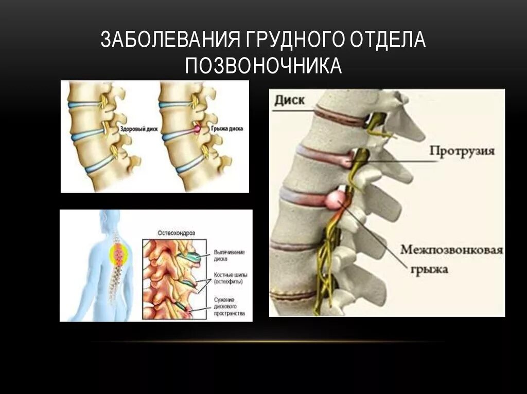 Грудной отдел позвоночника это. Остеохондроз грудного отдела позвоночника. Грудной отдел позвоночника заболевания. Позвонки грудного отдела позвоночника. Остеохондроз среднегрудного отдела.