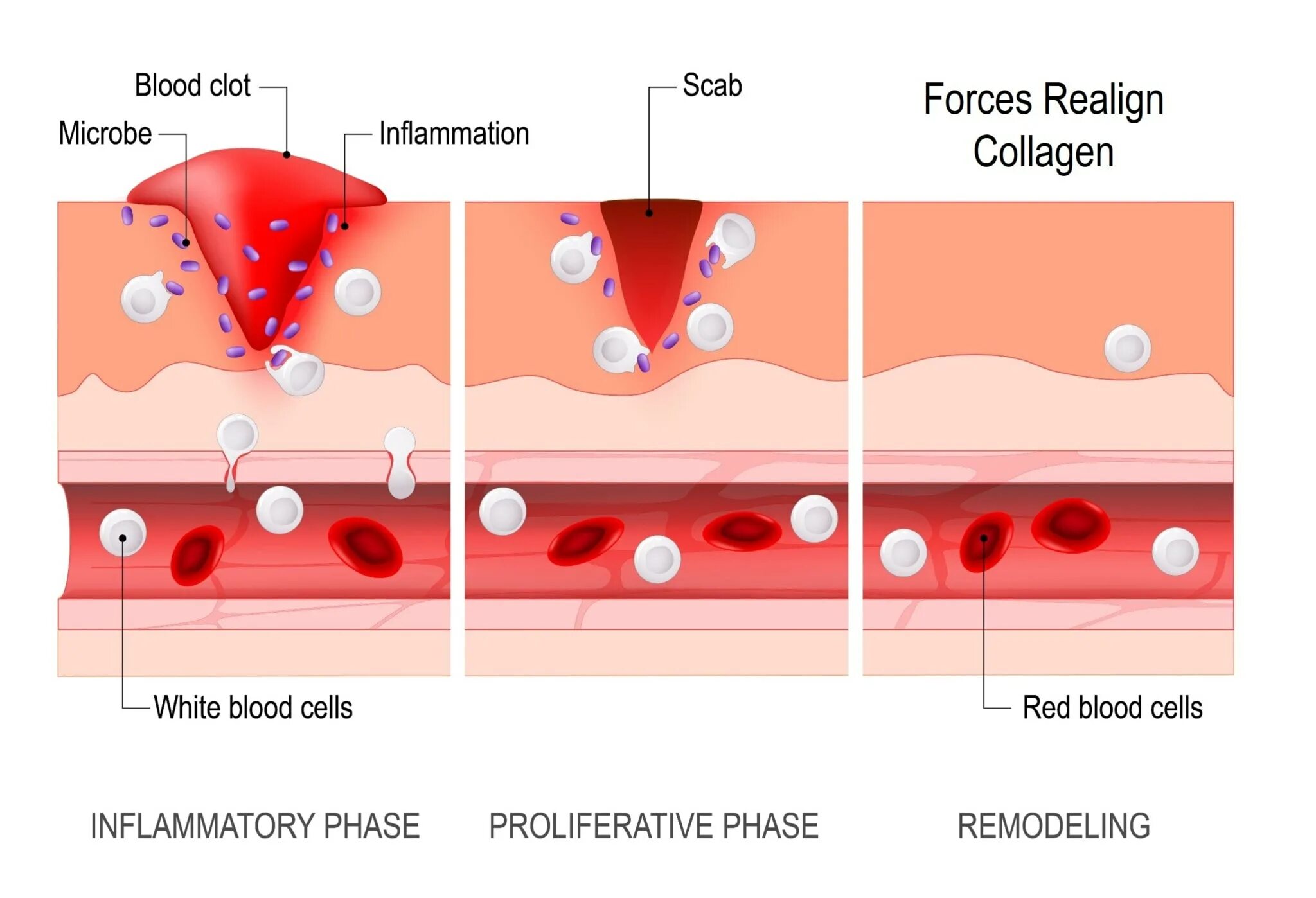Схема патогенеза хронического воспаления. Постинфекционный флебит. Патогенные факторы и повреждения. Повреждение тканей воспаление. Схема патогенеза хронического воспаления.