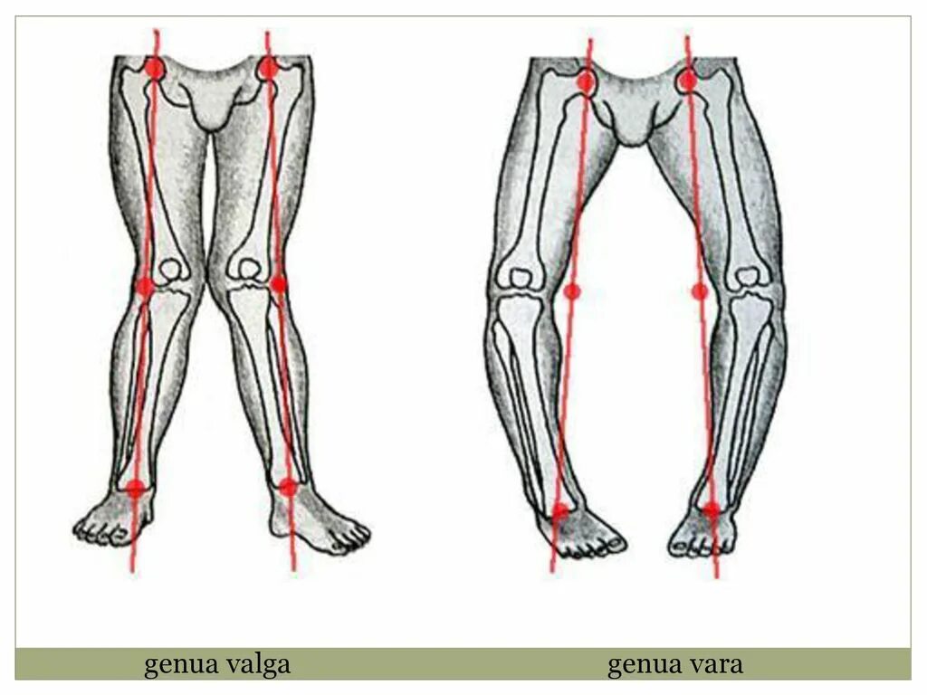 Варусная деформация коленных суставов. Варусная деформация коленных суставов у взрослых. Варусная и вальгусная деформация коленного сустава. Вальгусная деформация ног Genu Varum.