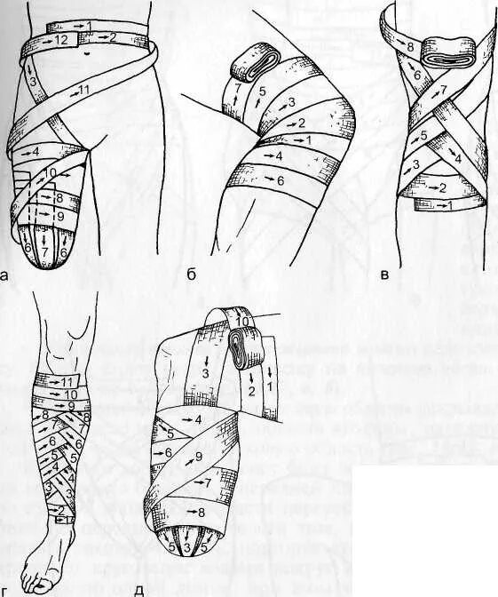 Наложение эластичного бинта на конечность. Техника бинтования культи. Перевязка тазобедренного сустава эластичным бинтом. Бинтование культи эластичным бинтом. Бинтование бедра.