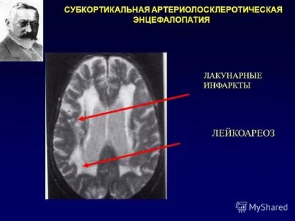 Лейкоареоз головного мозга что это