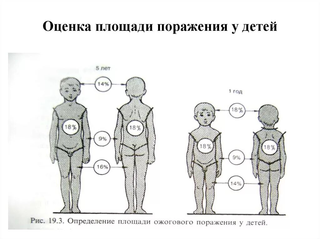 Площадь поражения при ожогах. Площадь поражения при ожогах у детей. Определение площади поражения. Оценка площади поражения..