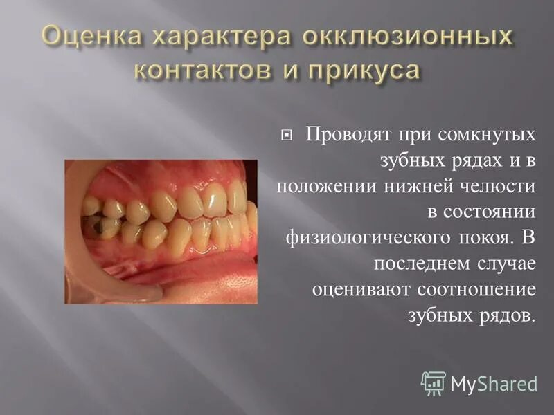 Соотношение зубных рядов. Соотношение зубных рядов