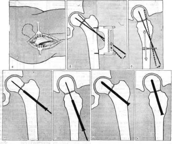 Операция остеосинтез шейки бедра. Перелом шейки бедра остеосинтез. Перелом шейки бедра операция. Аддукционный перелом шейки бедра. Остеосинтез при переломе шейки бедра.
