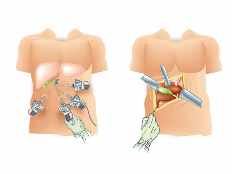 После удаления желчного пузыря. Холецистэктомия операция лапаротомия. Холецистит и лапароскопическая холецистэктомия. Лапароскопическая хирургия желчный пузырь. Холецистэктомия желчного пузыря лапароскопическая.