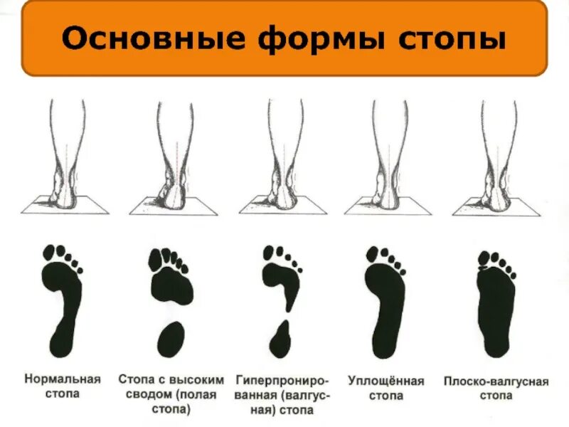 Нарушения стопы. Отпечаток стопы при плоскостопии 3 степени. отпечаток стопы норма и плоскостопие. сводчатая стопа и плоскостопие. плоскостопие поперечное отпечаток ноги.