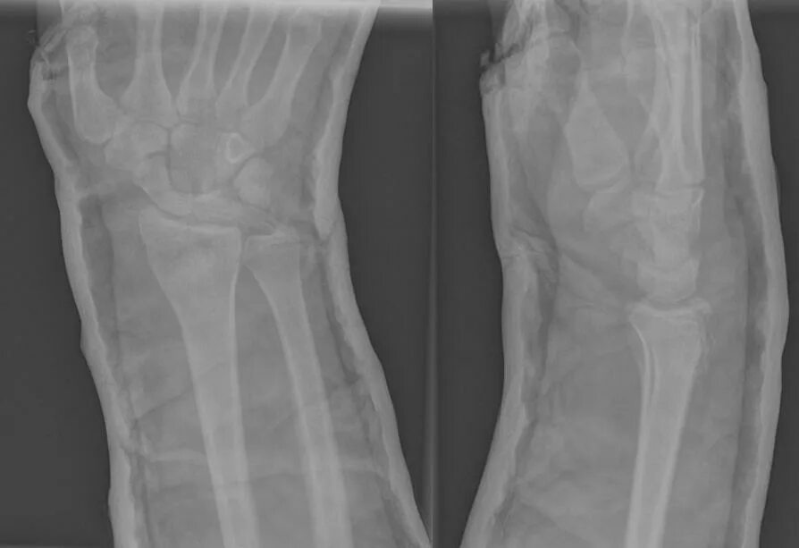 Закрытый оскольчатый перелом дистального метаэпифиза. Перелом дистального метаэпифиза лучевой кости. Перелом дистального метаэпифиза лучевой кости рентген снимок. Краевой перелом дистального эпифиза лучевой кости. Перелом эпиметафиза плечевой кости.