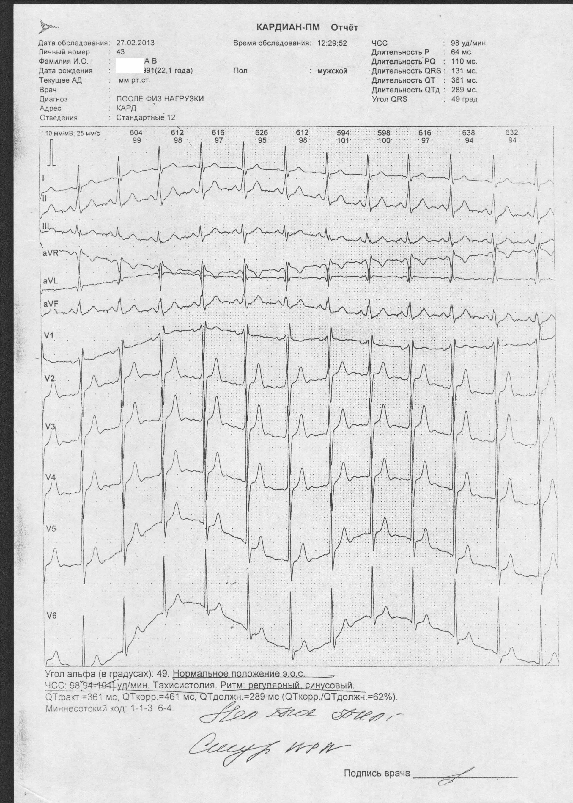 Тахисистолия на ЭКГ. Тахисистолия диагноз. Синусовая тахисистолия карта вызова. Угол Альфа на ЭКГ.