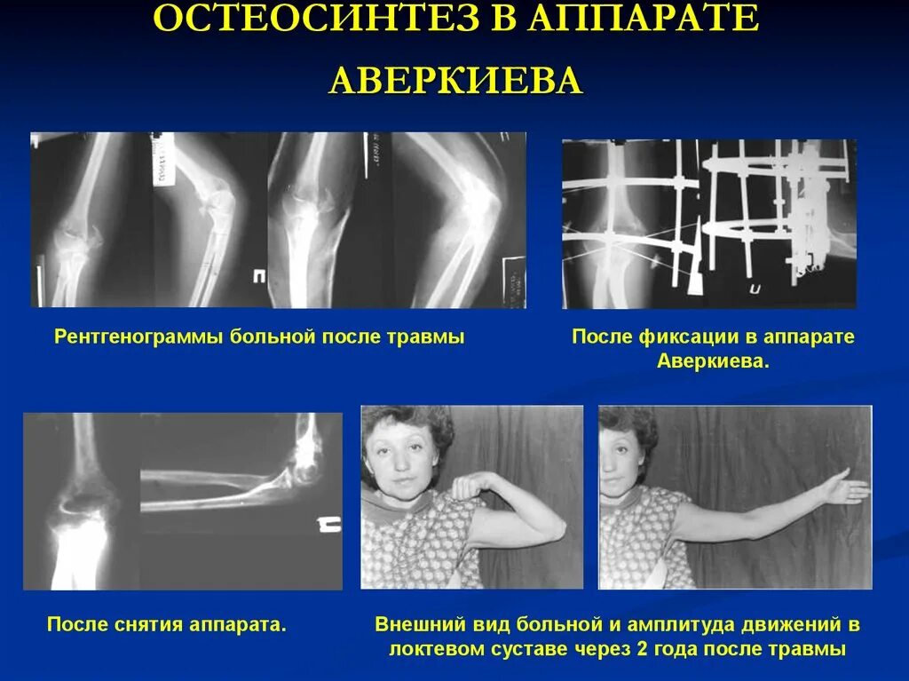 Локтевой сустав инвалидность. Остеосинтез локтевого сустава. аппарат наружной фиксации локтевого сустава.