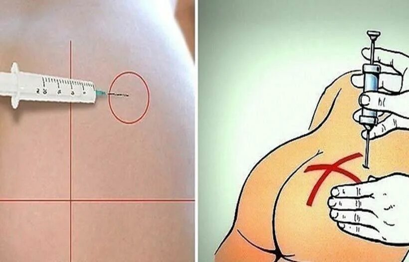 Алгоритм правильной чистки зубов. Планка для похудения живота. Как правильно самому после. Как самой себе сделать укол внутримышечно в бедро. Асахи зоган.