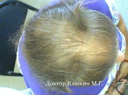 Онкология волос