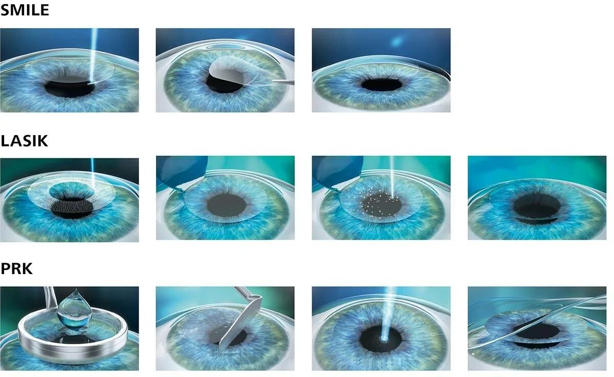 Фемто ласик после операции. Этапы лазерной коррекции зрения ласик. lasik лазерный кератомилез. лазерная рефракционная кератопластика (методом femto super lasik). коррекция зрения фемто ласик.