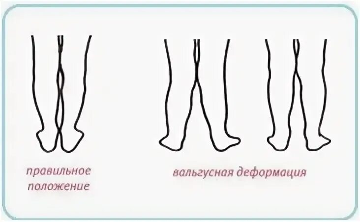 Вальгусная установка стопы мкб 10