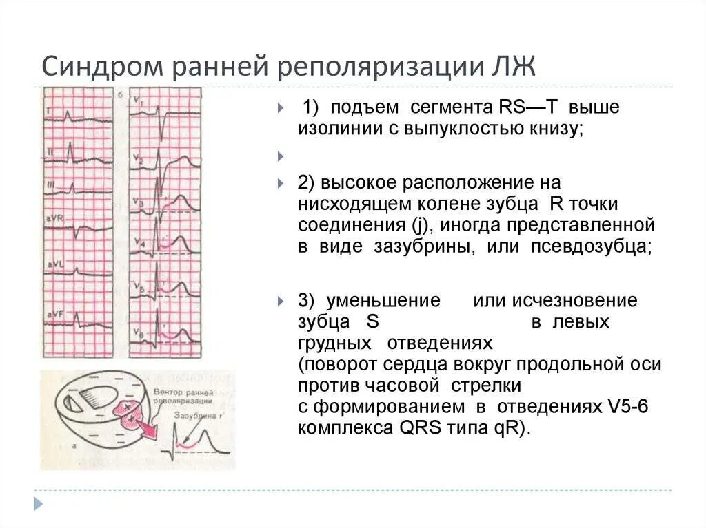 Синдром ранней реполяризации на ЭКГ. Ранняя реполяризация лж на ЭКГ. Синдром преждевременной реполяризации желудочков на ЭКГ. Синдром ранней реполяризации желудочков на ЭКГ У взрослых.