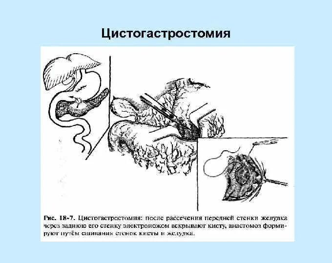Операции на поджелудочной железе. Цистогастростомия кисты поджелудочной железы. цистогастральный анастомоз. эндоскопическое дренирование поджелудочной железы. дренирование кисты поджелудочной железы.