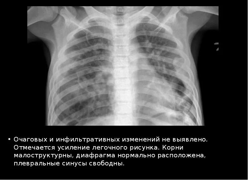 Корни малоструктурные что значит. Очагово инфильтративных изменений. Очаговых и инфильтративных изменений не выявлено. Очагово-инфильтративные изменения. Лёгкие без очаговых и инфильтративных изменений.