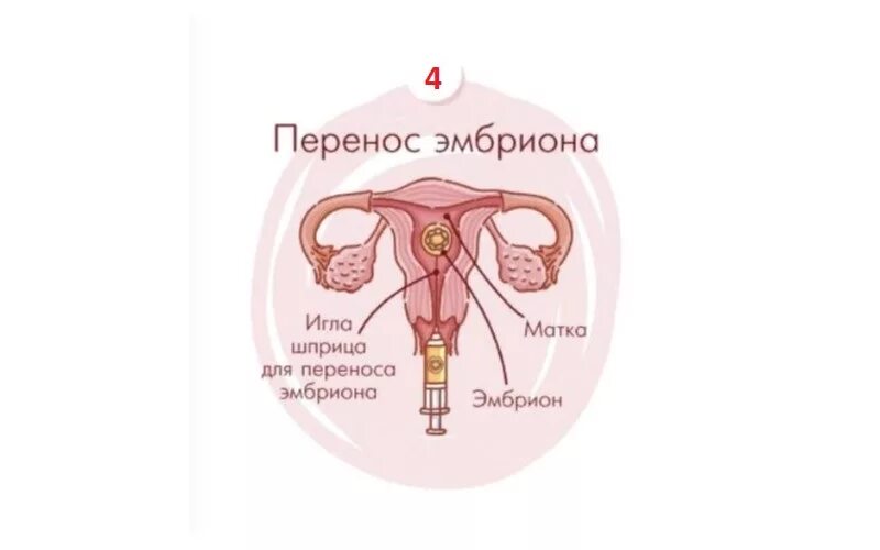 Подсадка эмбрионов при эко. Перенос эмбриона в матку. перенос эмбрионов в полость матки.