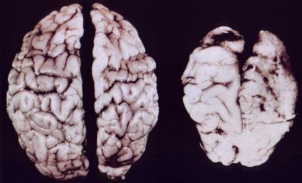 Алкогольная энцефалопатия патологическая анатомия. Мозг человека алкоголика. Последствия поражения мозга
