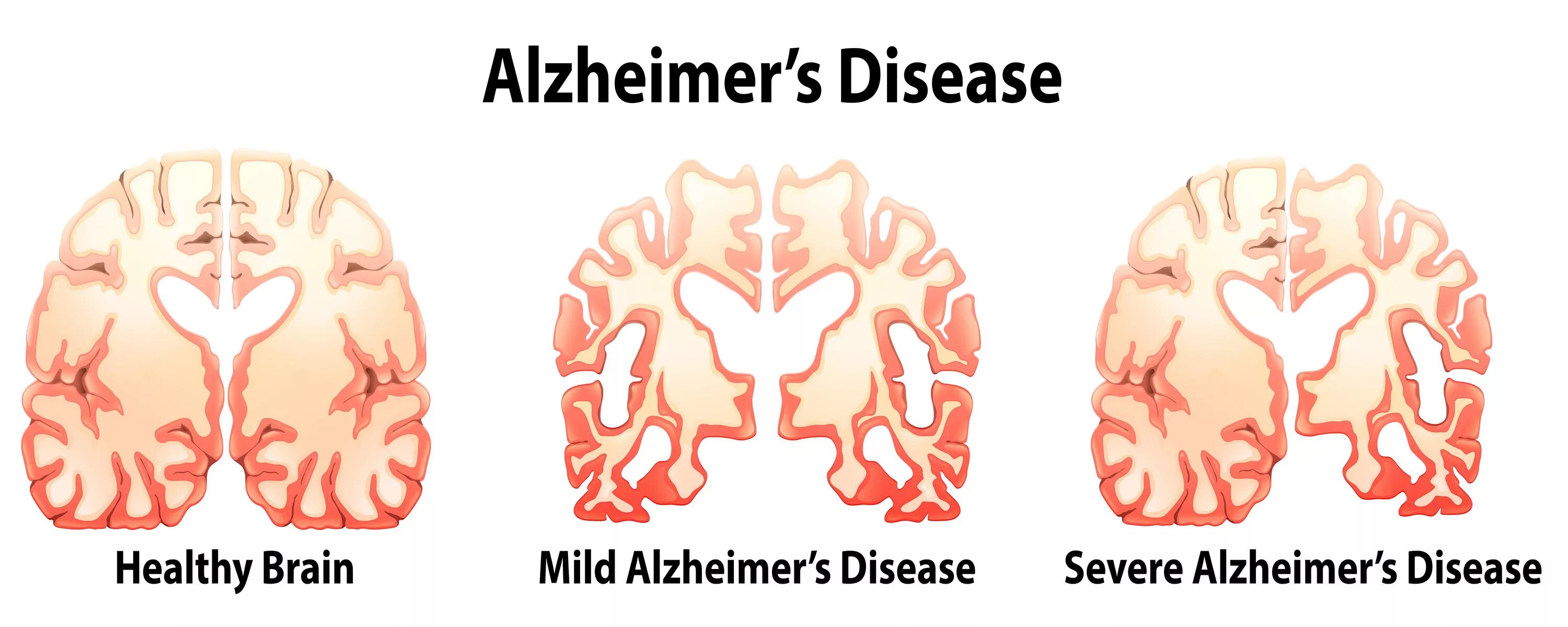 Болезнь айцгельмера это что. Болезнь Альцгеймера. Синдром Альцгеймера. Болезнь Альцгеймера картинки.