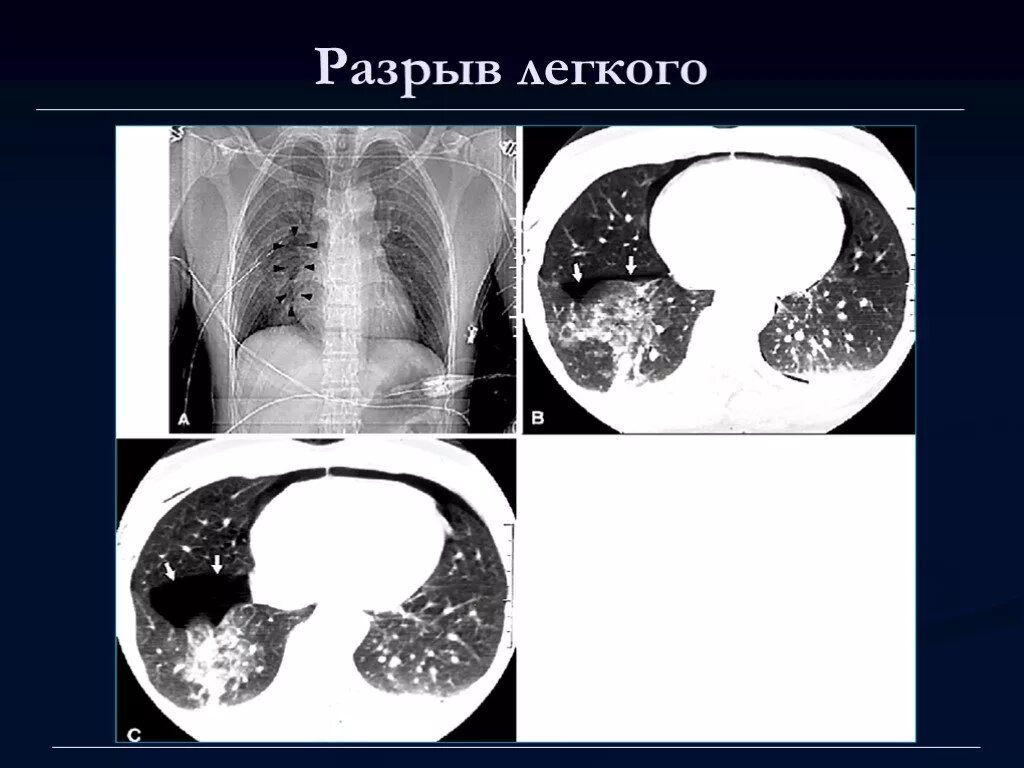 Признаки повреждения легких. Разрыб лёгкого кт. Признаки повреждения легкого.