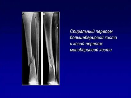 Винтообразный перелом