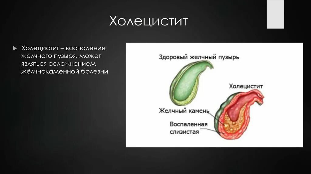 Холецистит темы