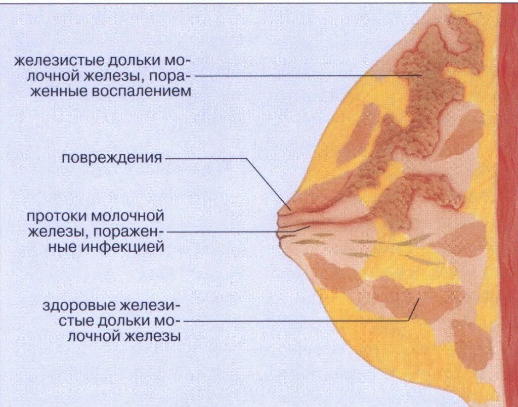 Что такое лактостаз. Лактостаз.