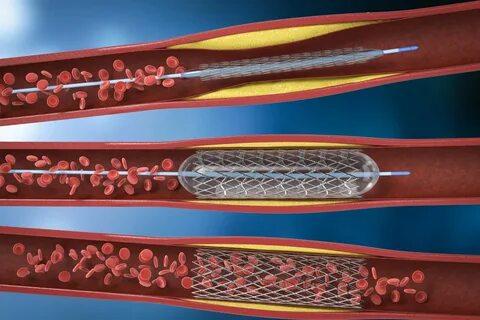 Global Dual Balloon Angioplasty Catheters Industry