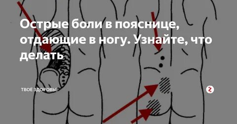 Боли в ягодицах при сидении у женщин